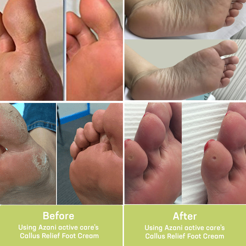 Callus Relief Foot Cream