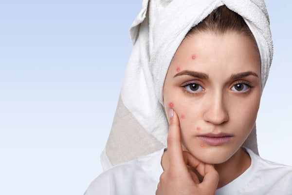 Why do breakouts happen on your skin? Tips to avoid it