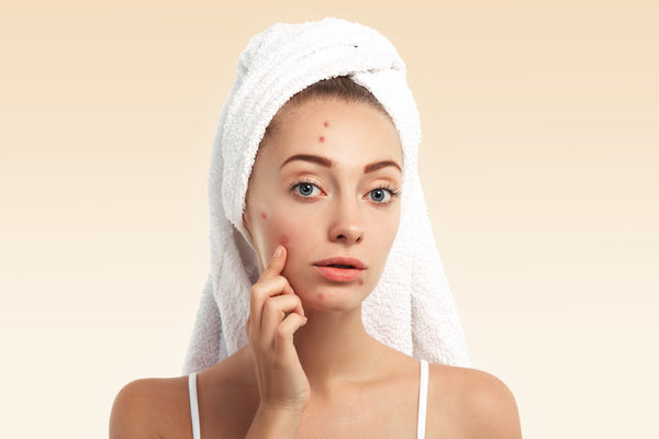 Acne Scars: How to make them disappear from skin