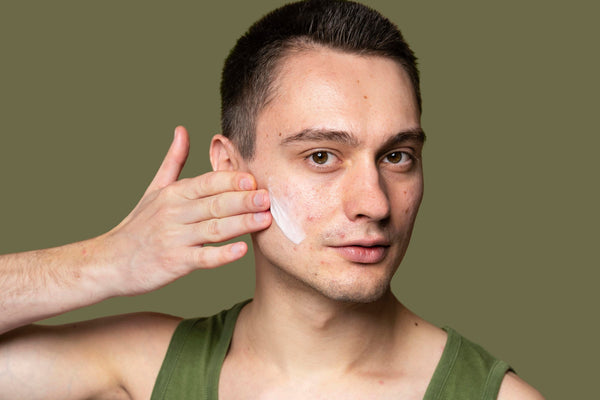 Adult Acne- Causes, Preventions & Tips