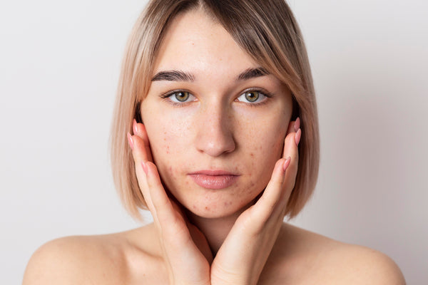 The Importance of Lactic Acid in your skincare regime