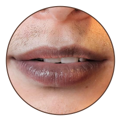 Darken or hyper pigmented lips