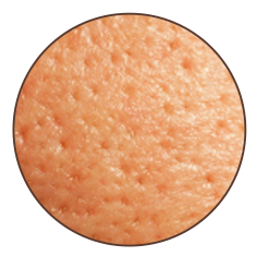 Acne Blemishes
