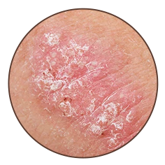 Dry and flaky patches