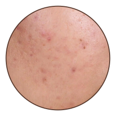 Active acne