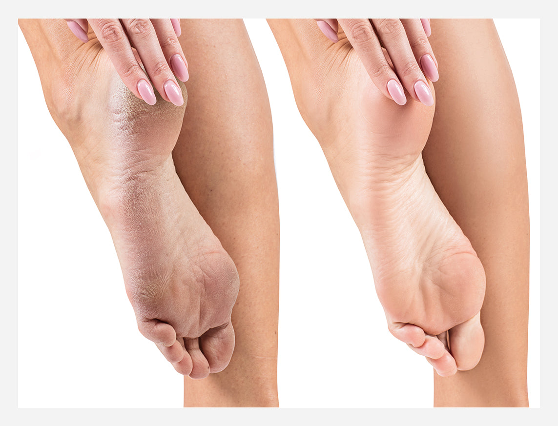 Preventing Dry, Cracked Heels This Winter | Dynamic Foot and Ankle Center