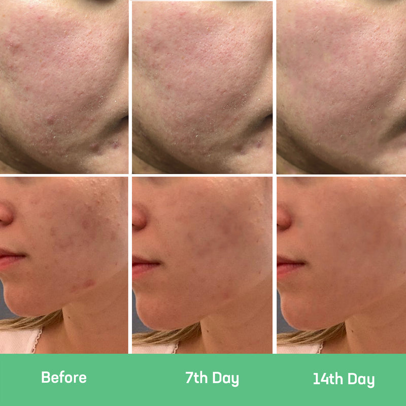 Before and After-Lactic Acid Resurfacing Serum
