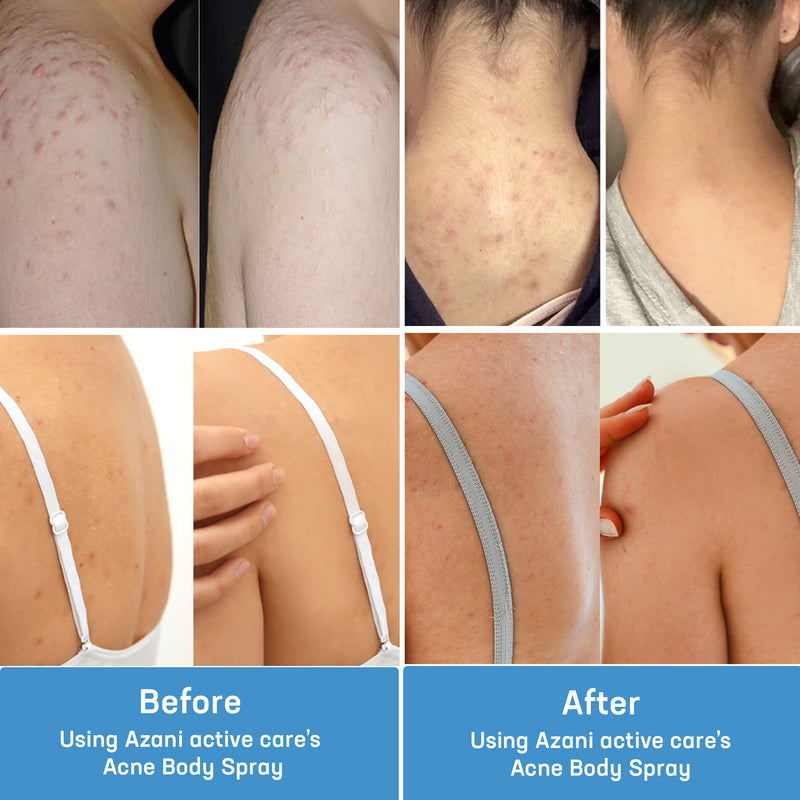 Before & After-Acne Body Spray